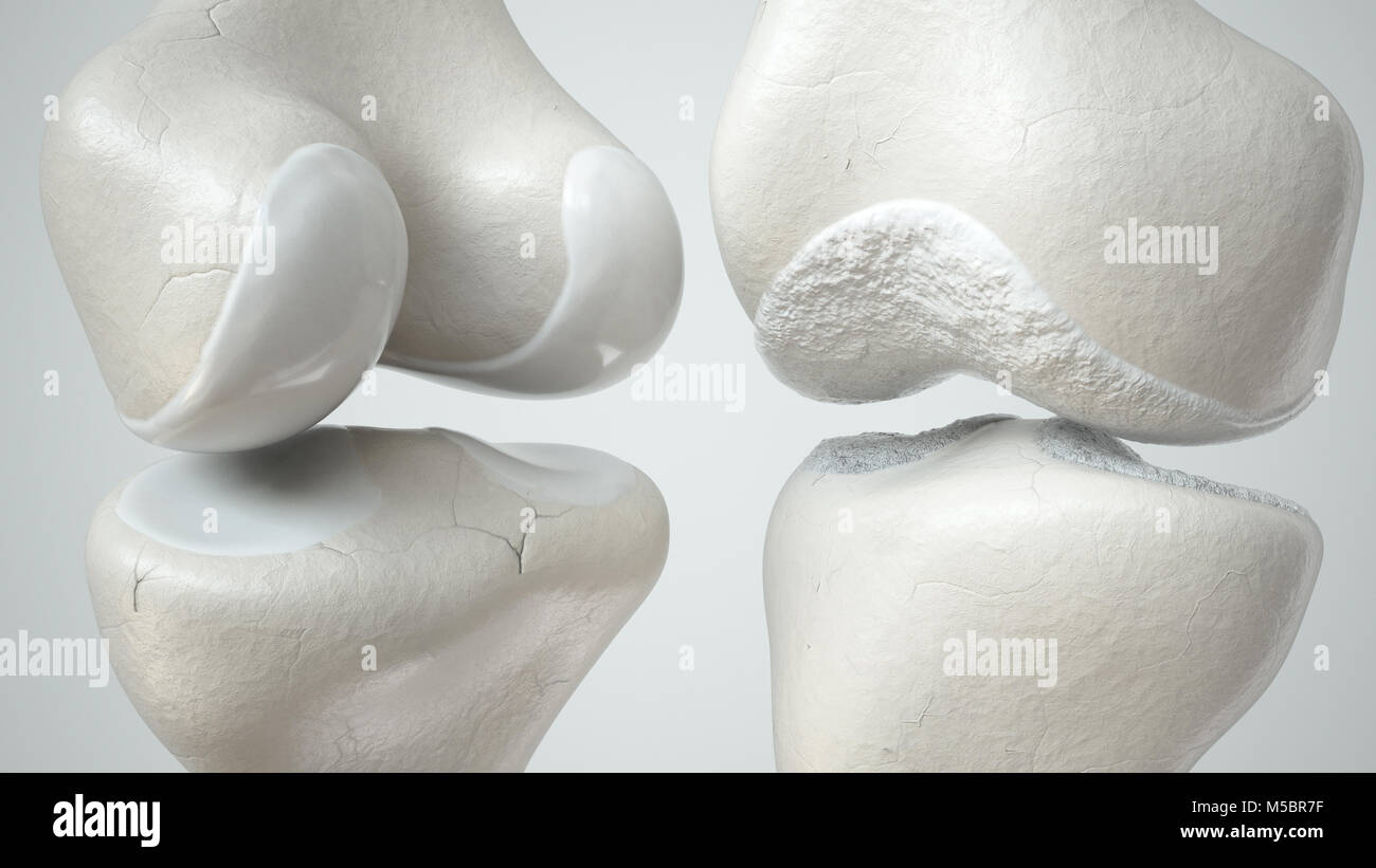 Sana e osteoartrite del ginocchio coperto - 3D Rendering Foto Stock