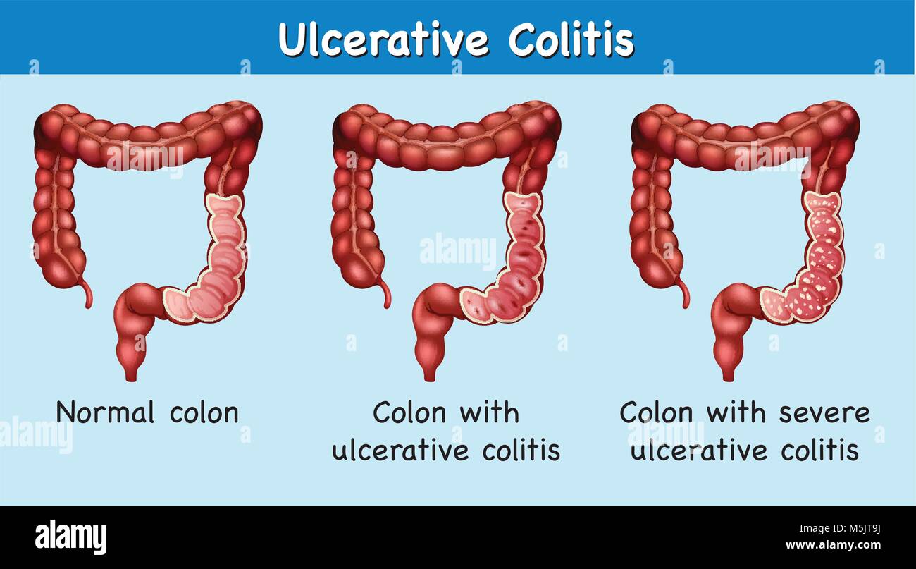 Diagramma che mostra la colite ulcerosa illustrazione Immagine e Vettoriale Alamy Diagramma che mostra la colite ulcerosa illustrazione Immagine e Vettoriale Alamy