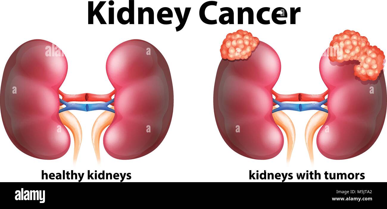 Diagramma che mostra il cancro del rene in figura umana Illustrazione Vettoriale