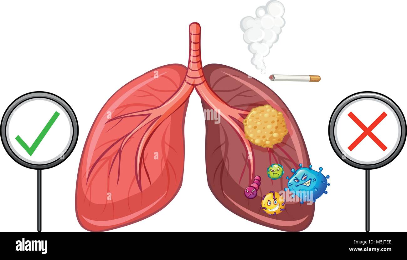 Diagramma che mostra una sana e malsano polmoni illustrazione Illustrazione Vettoriale