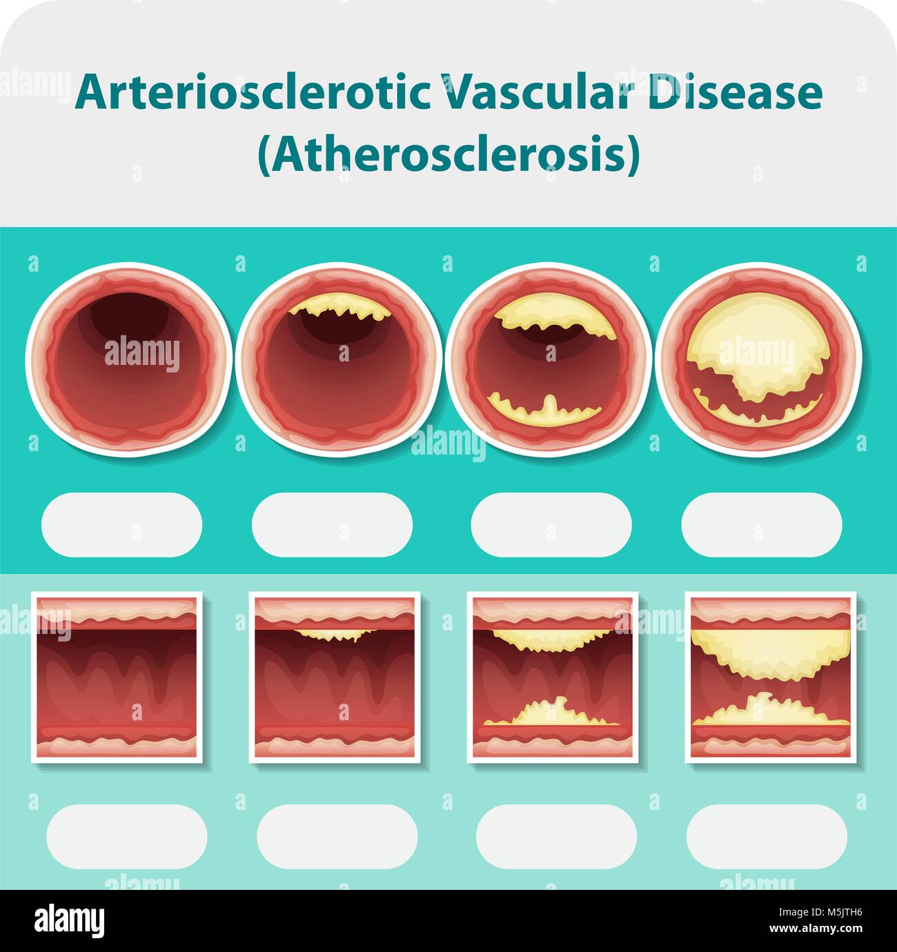 Diagramma che mostra arteriosclerotica malattia veascular illustrazione Illustrazione Vettoriale