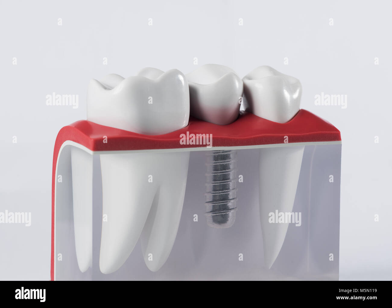 Dente impianto umano. Concetto dentale. Foto Stock