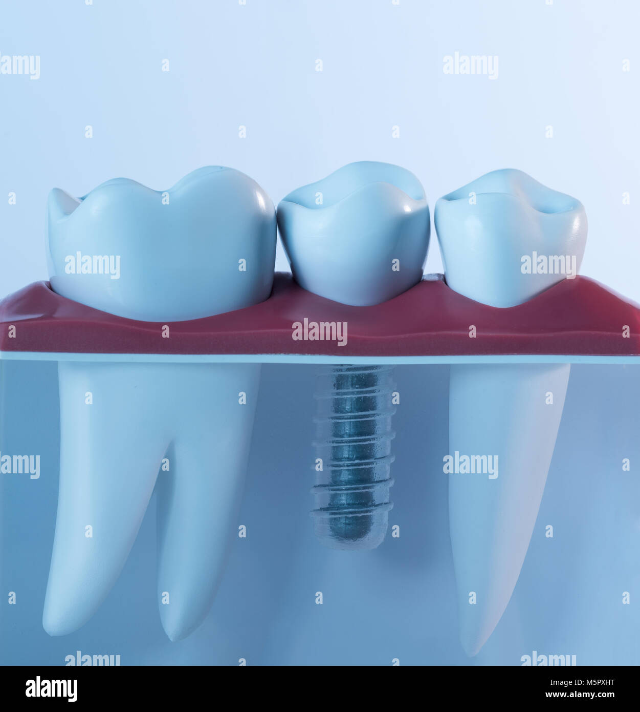 Dente impianto umano. Concetto dentale. Foto Stock