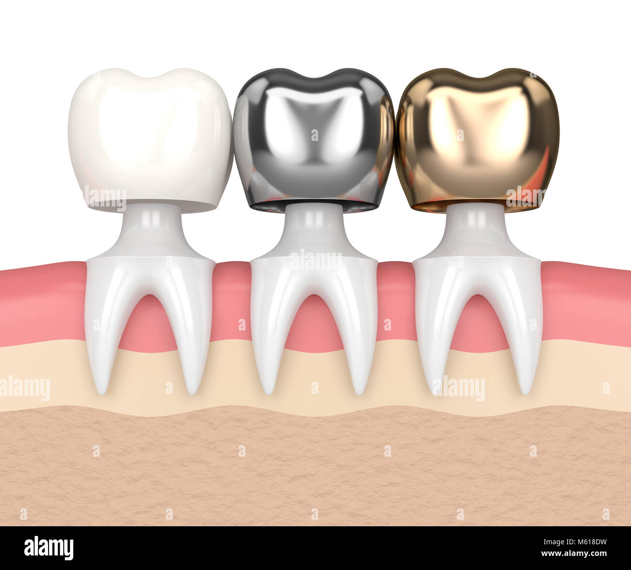 Kit 6 Strumenti Restaurativi Dentali In Composito – Rivestimento Oro – FABCO