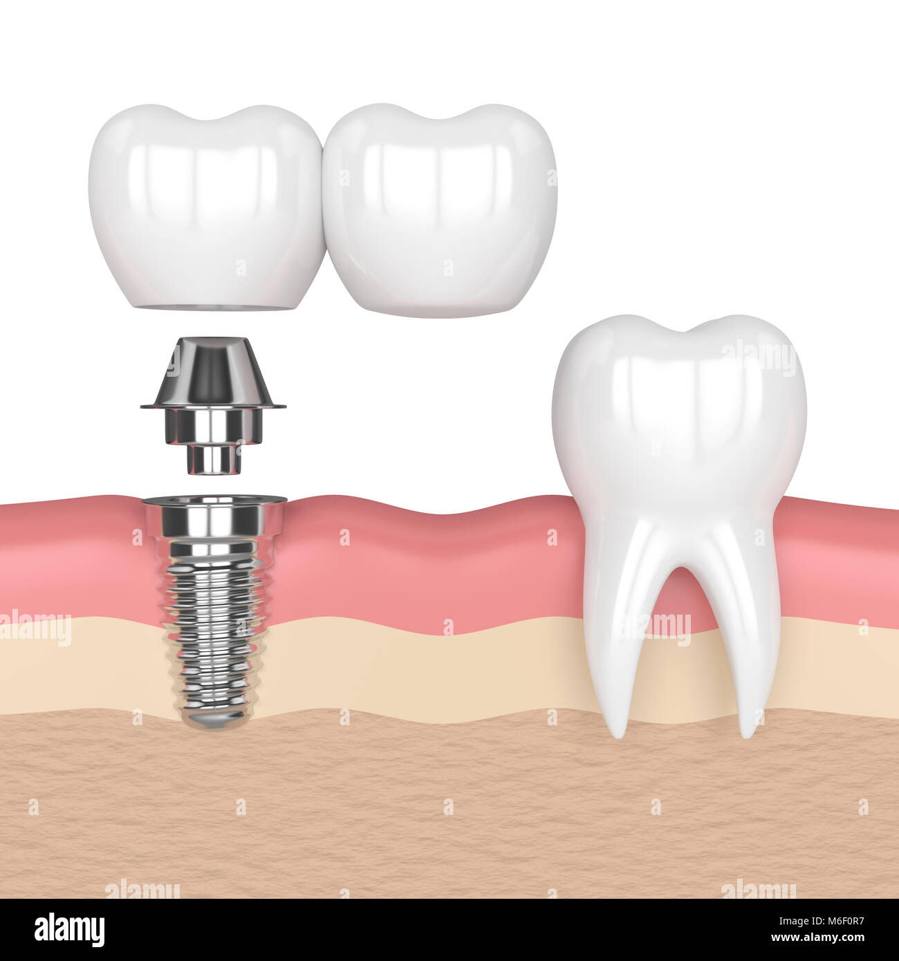 Luxylei Modello di Impianto Dentale - Analisi Rimovibile 4 Volte