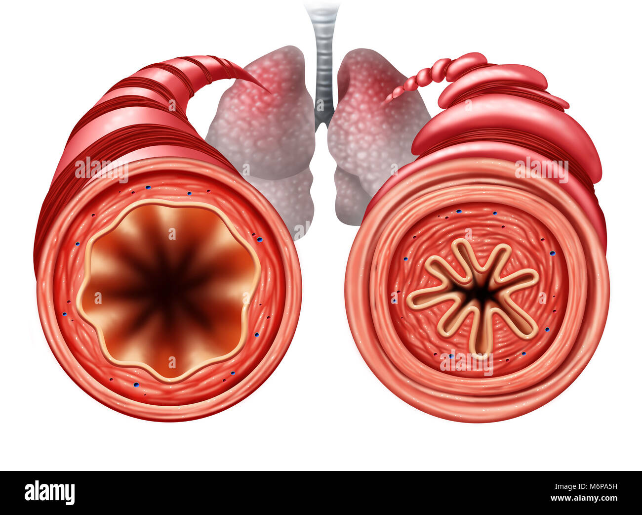 Asma diagramma come un sano e malsano tubo bronchiale con una respirazione ristretta problema causato da muscolo respiratorio il serraggio. Foto Stock