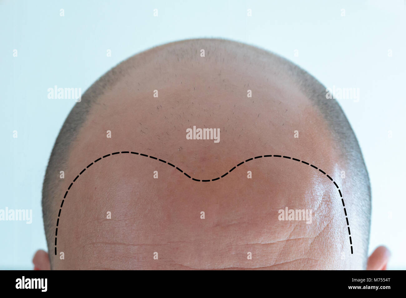 Vista di uomo calvo di testa con la perdita dei capelli Foto Stock