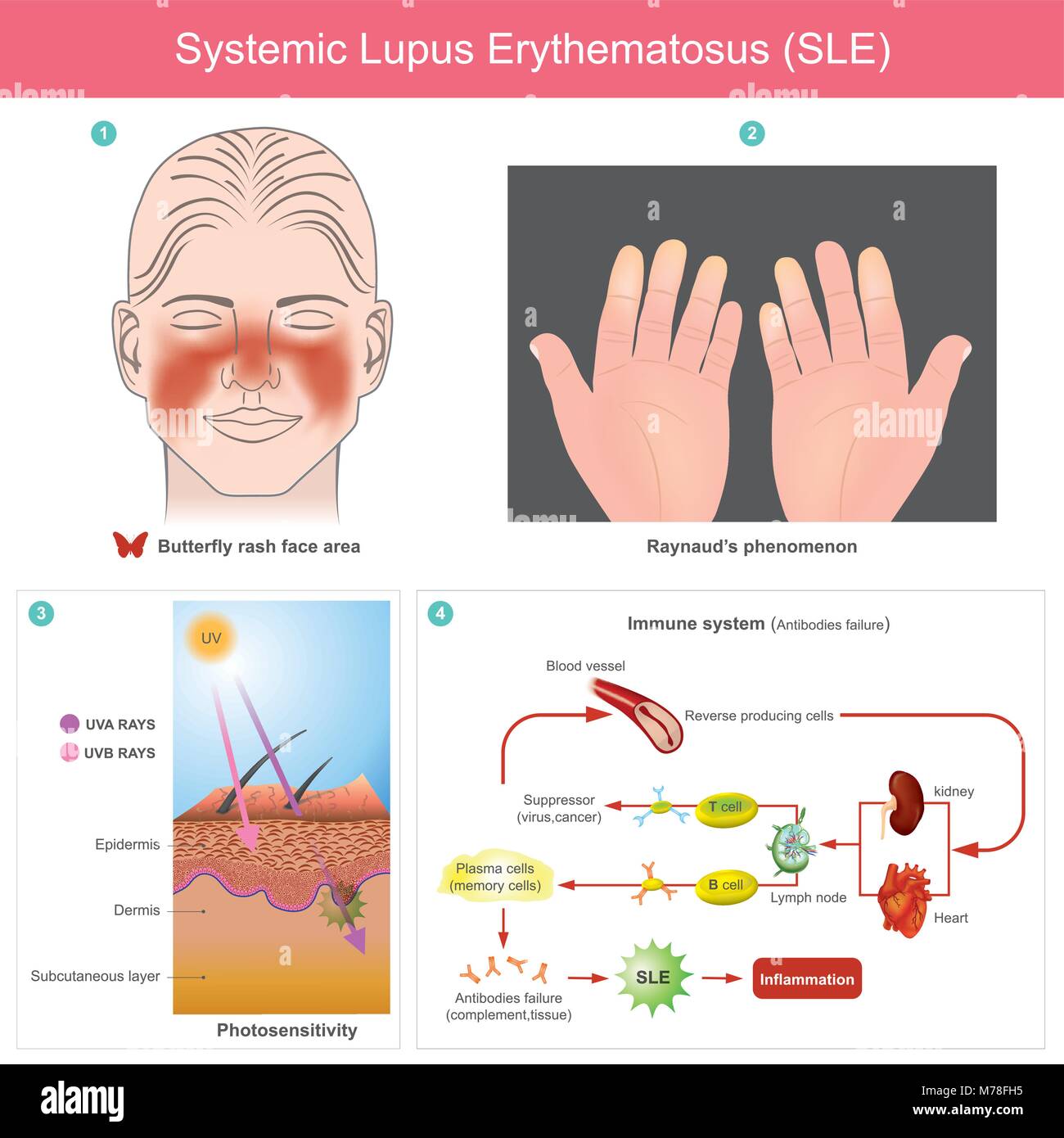 I pazienti infiammazione della pelle dalla luce. Illustrazione. A causa della perdita della tolleranza verso il self conduce al sistema immunitario mediata danni alle auto Il b Illustrazione Vettoriale