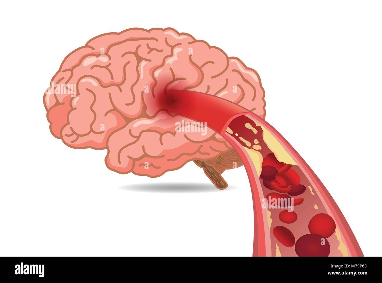 Colesterolo nelle vene fatto rallentare il flusso di sangue nel cervello. Illustrazione Vettoriale