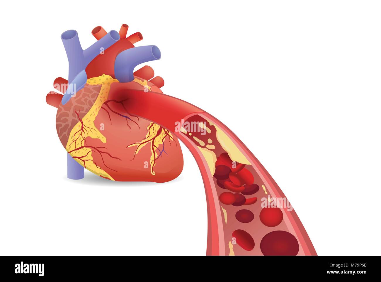 Cellule del sangue non è in grado di fluire nel cuore umano perché arterie intasate da grassi. Illustrazione Vettoriale