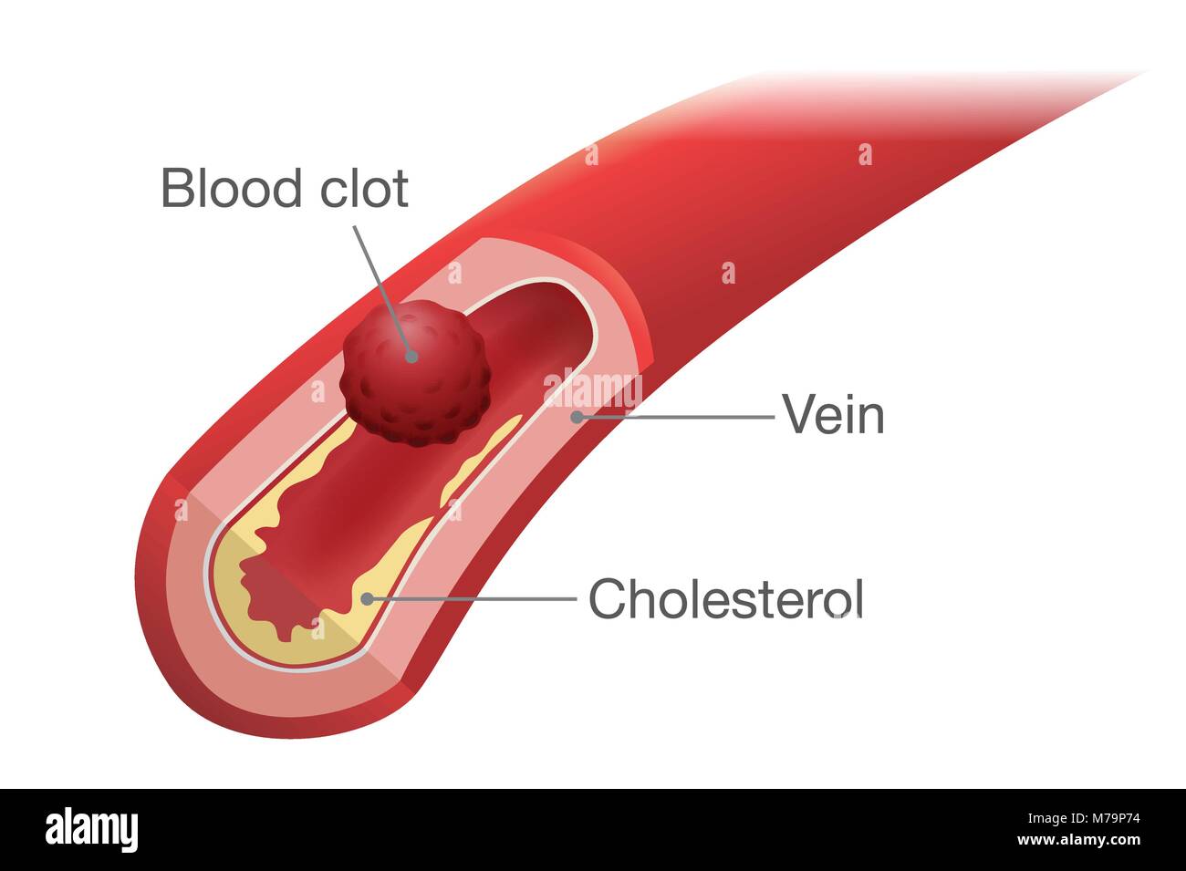 Di coagulo di sangue si verifica in una vena. Illustrazione Vettoriale