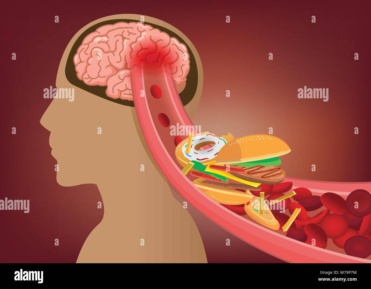 Il sangue non è in grado di fluire nel cervello umano perché il fast food realizzati arterie intasate. Illustrazione Vettoriale
