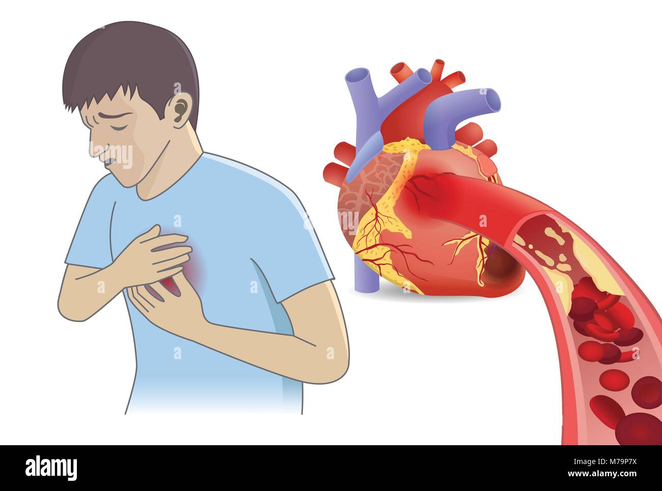 L'uomo hanno dolore toracico da cellule del sangue non è in grado di fluire nel cuore da grassi. Illustrazione Vettoriale