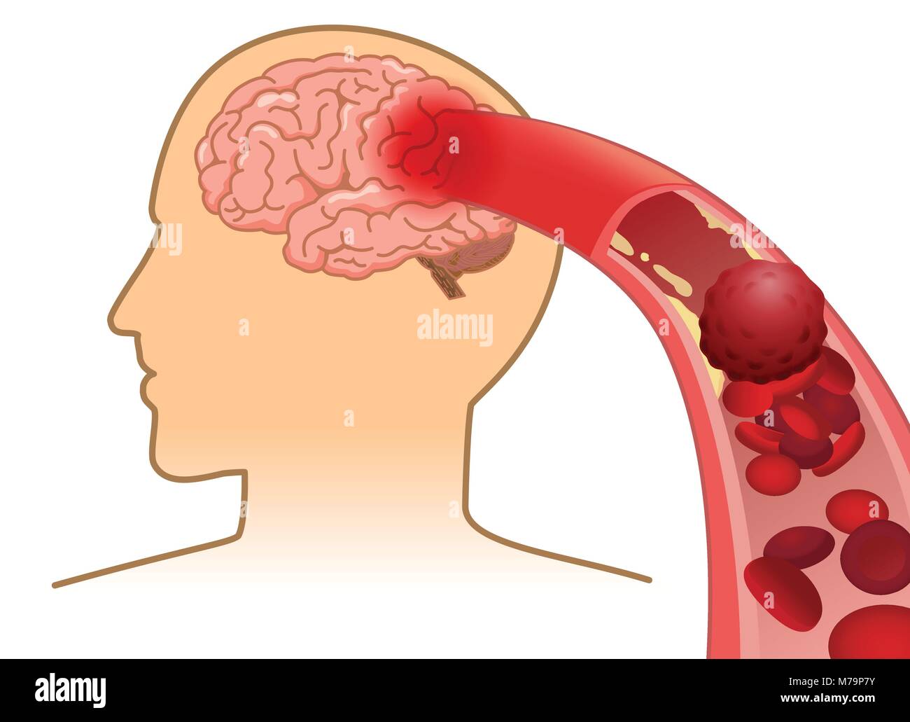 Cella di sangue non può fluire nel cervello umano perché arterie intasate da coagulo di sangue. Illustrazione Vettoriale