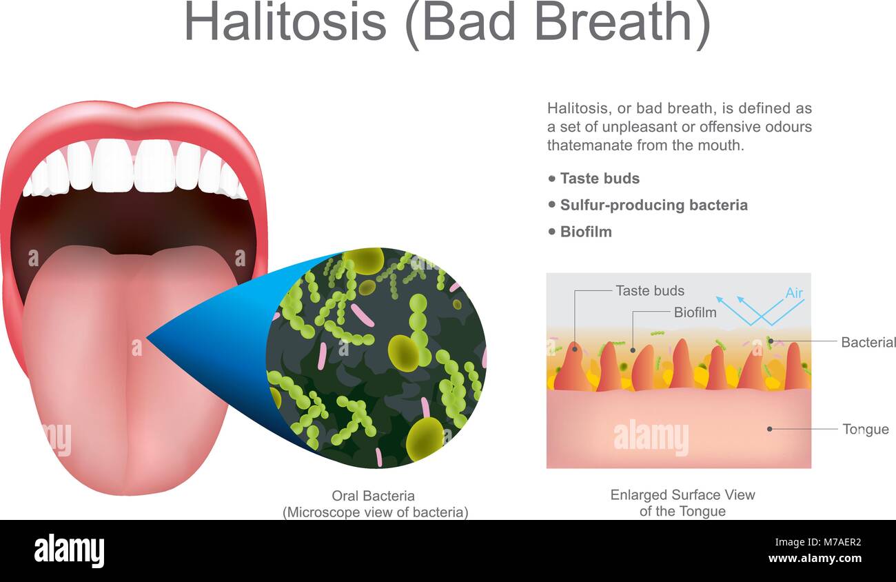 Alitosi o alito cattivo. Istruzione info grafica. Il design del vettore. Illustrazione Vettoriale