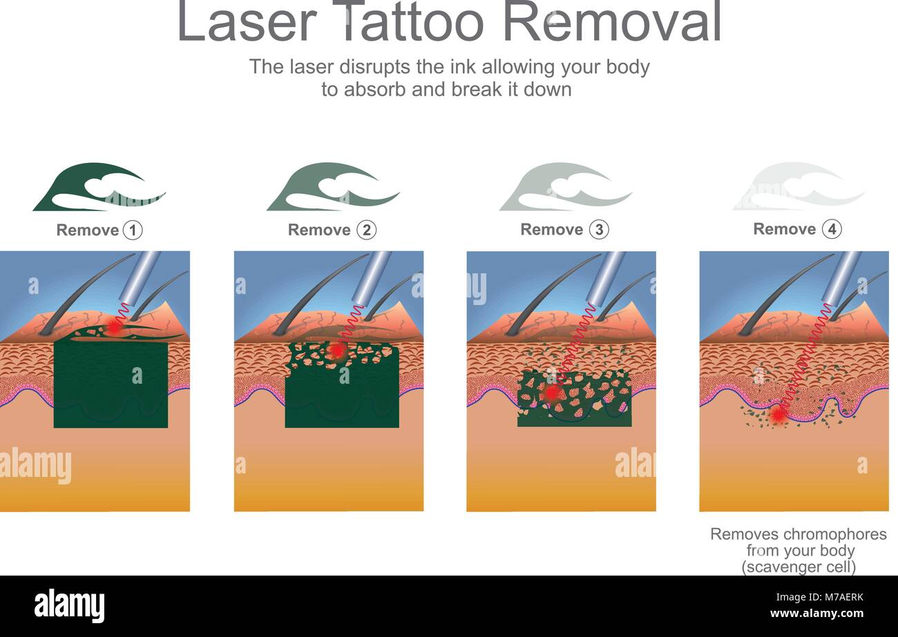Rimozione dei tatuaggi è più comunemente eseguita utilizzando laser che abbattere le particelle di inchiostro del tatuaggio. Istruzione ed infografico. Il design del vettore. Illustrazione Vettoriale