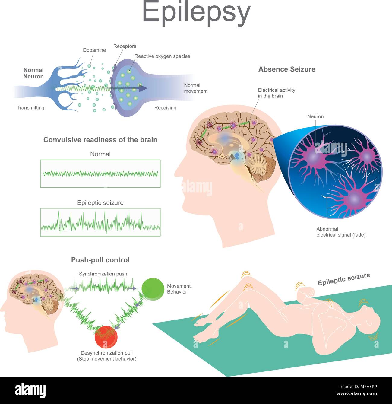 Epilessia è un gruppo di disturbi neurologici caratterizzati da attacchi epilettici. Gli attacchi epilettici sono il risultato di un eccessivo e nervo anormali c Illustrazione Vettoriale