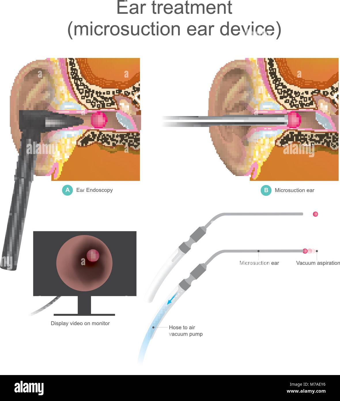 Il Micro orecchio di aspirazione dispositivo è vuoto sistema di lavoro. I medici utilizzano aria pompa a vuoto per aspirazione la forma a sfera all'interno del canale auricolare. Illustrazione. Illustrazione Vettoriale
