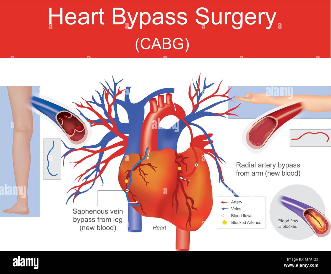 Una placca è arteria bloccata causa riduce il flusso di sangue. Un nuovo sangue come applicato da un altra parte del tuo corpo. Illustrazione dell'anatomia umana. Illustrazione Vettoriale