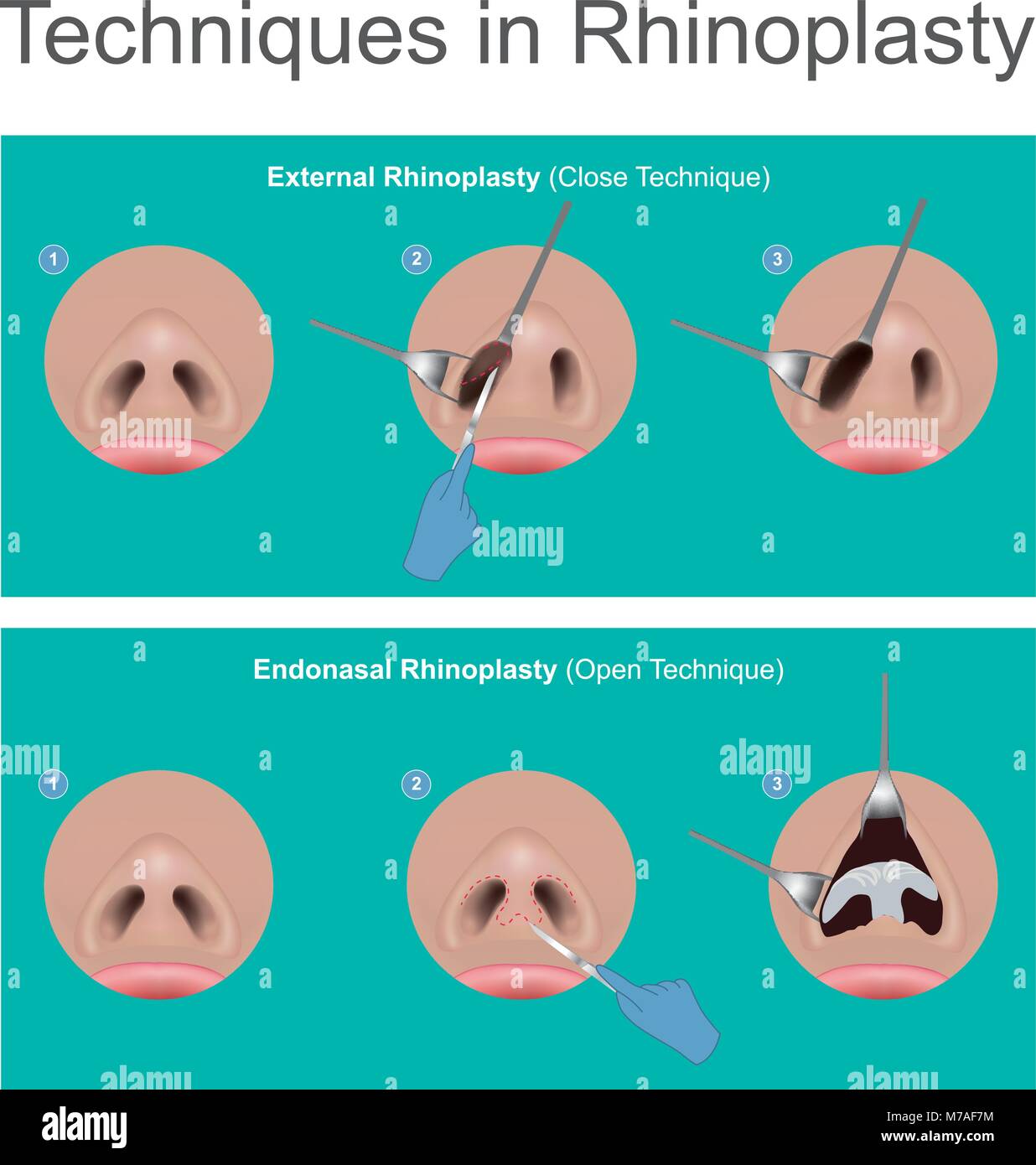 È un naso chirurgia crea un estetico, e facially proporzionate naso per correggere o altri problemi che influiscono sulla respirazione. Illustrazione. Illustrazione Vettoriale