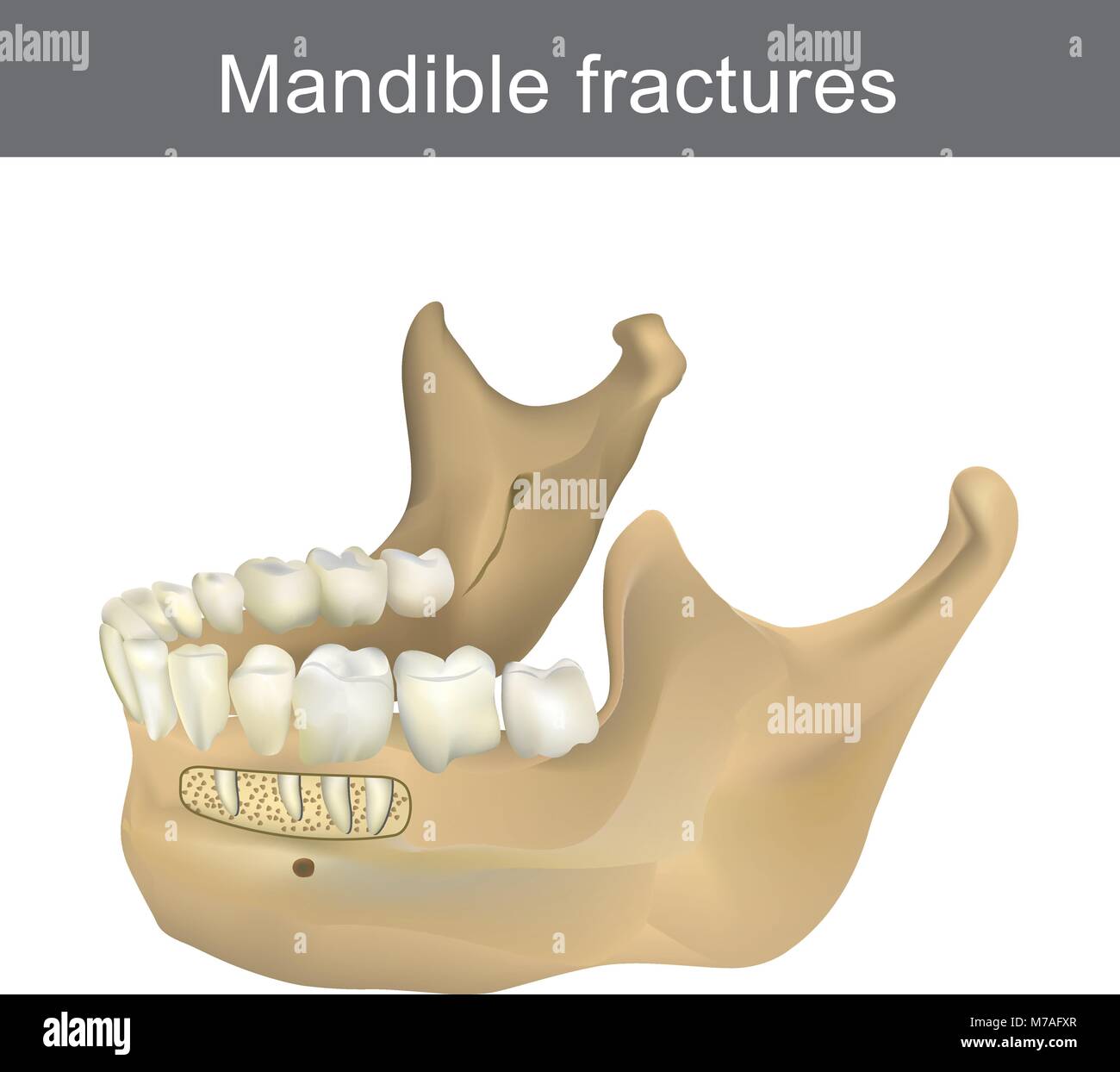 Mandibola fratture è la più grande e più forte e più basso in osso la faccia. Parte del corpo umano. Una infografica anatomia. Illustrazione Vettoriale