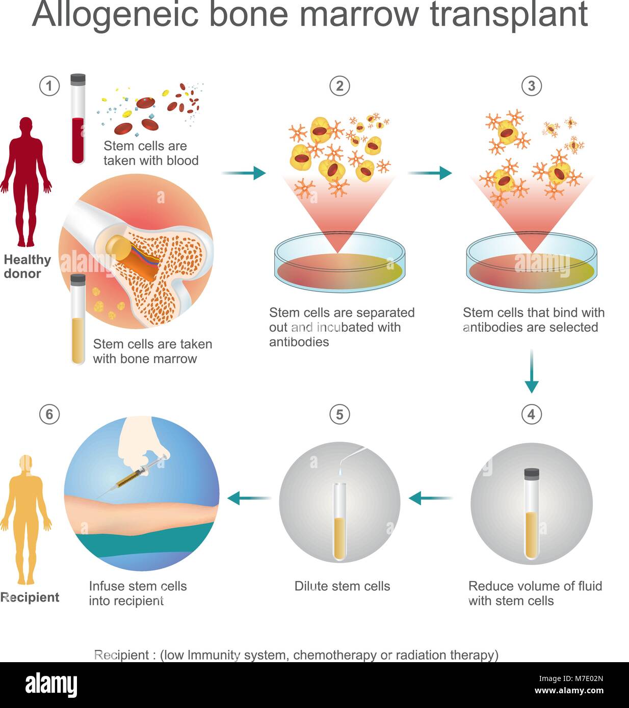 Il trapianto allogenico processo sono donati alla persona di un'altra persona, un geneticamente adattato di cellule staminali donatore. Info vettore grafico. Illustrazione Vettoriale