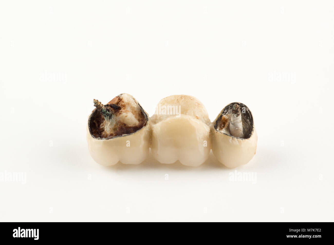 Danneggiato protesi cermet con parti rotte di denti Foto Stock