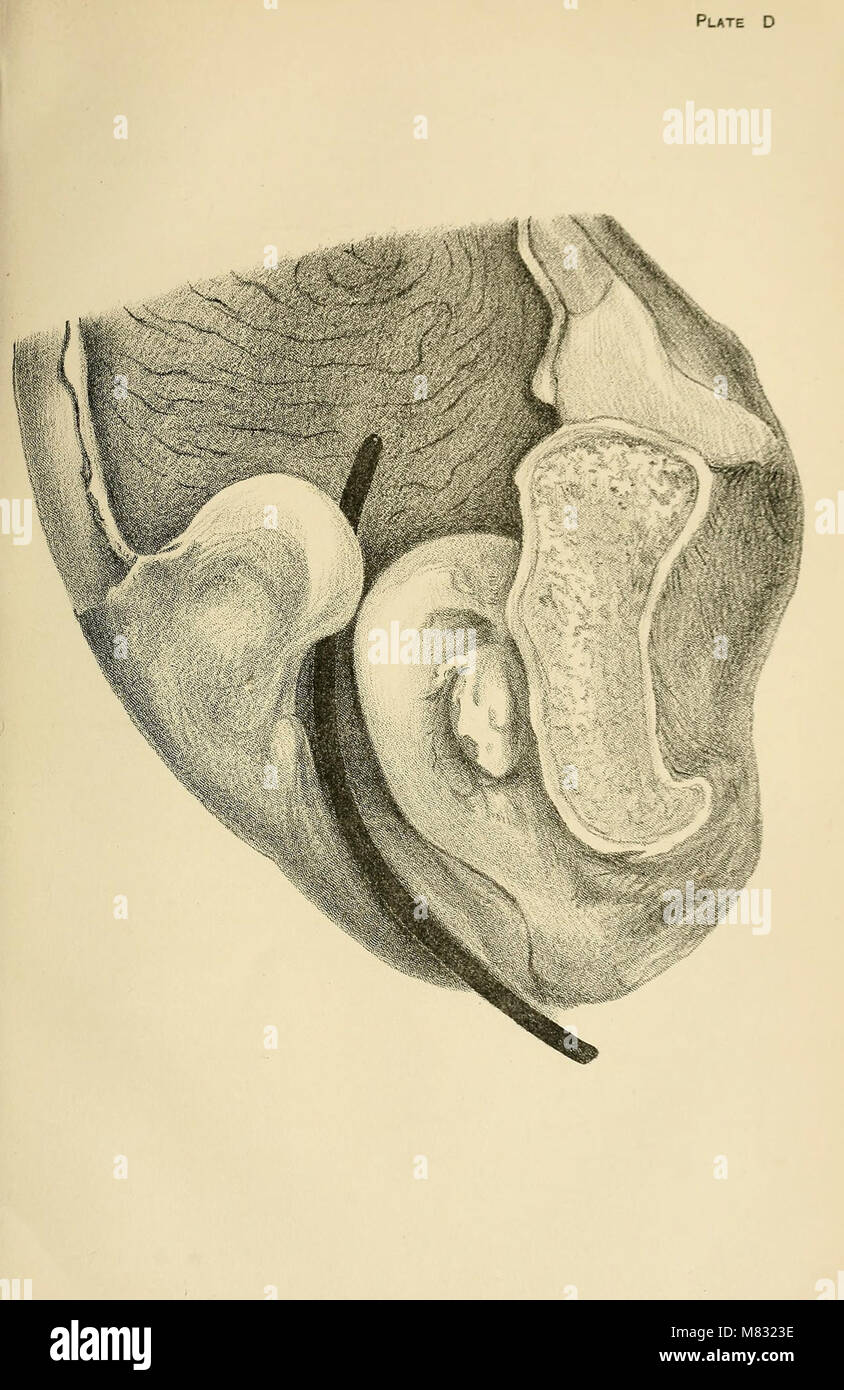 *Le lezioni cliniche sulla stenosi dell'uretra* (1878) riguardano le condizioni mediche relative al sistema urinario, concentrandosi su stenosi e altri disturbi dell'uretra e relativi organi. Foto Stock