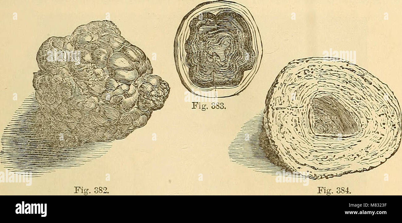 Clinica i principi e la pratica della medicina (1874) (14597016780) Foto Stock