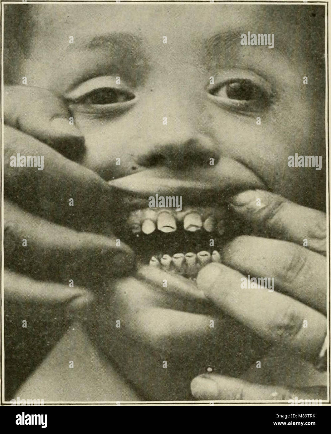 Generale e patologia dentale con particolare riferimento ad eziologia e anatomia patologica; un trattato per studenti e professionisti (1920) (14782316252) Foto Stock