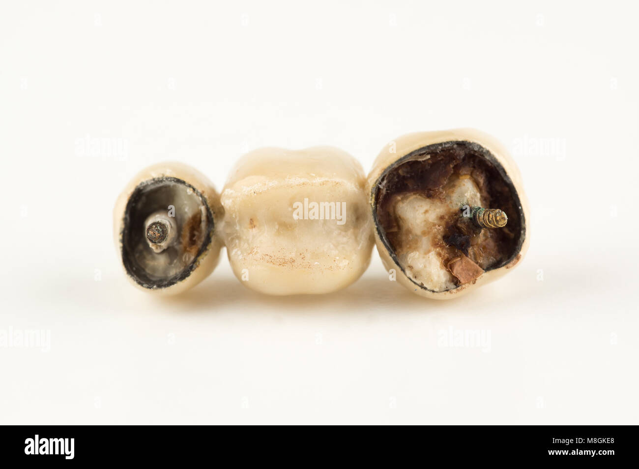 Danneggiato protesi cermet con parti rotte di denti Foto Stock