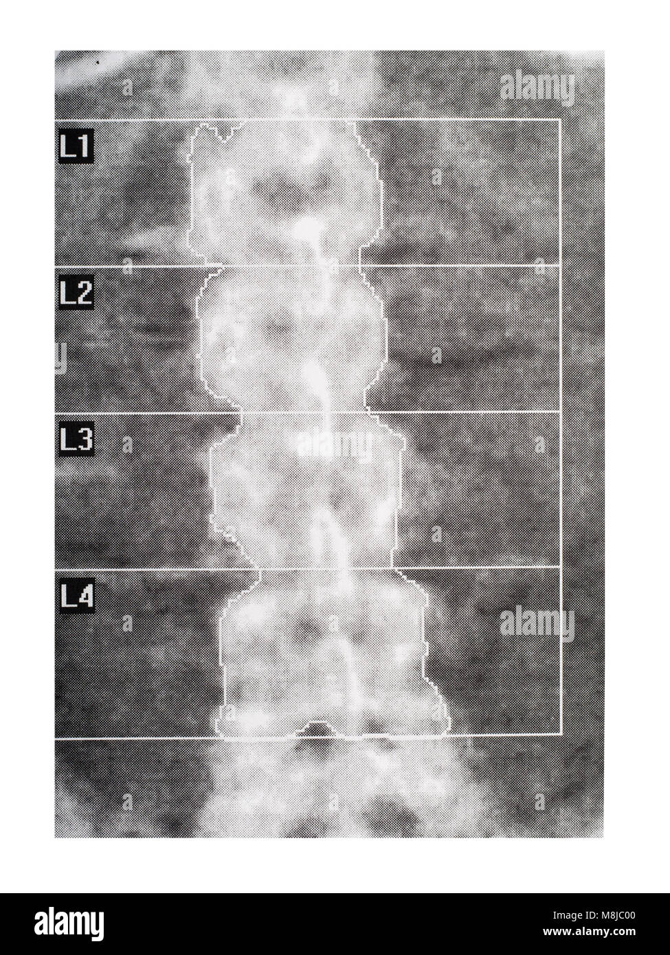 Scansione medica - colonna vertebrale. DEXA scan per l'osteoporosi. Foto Stock