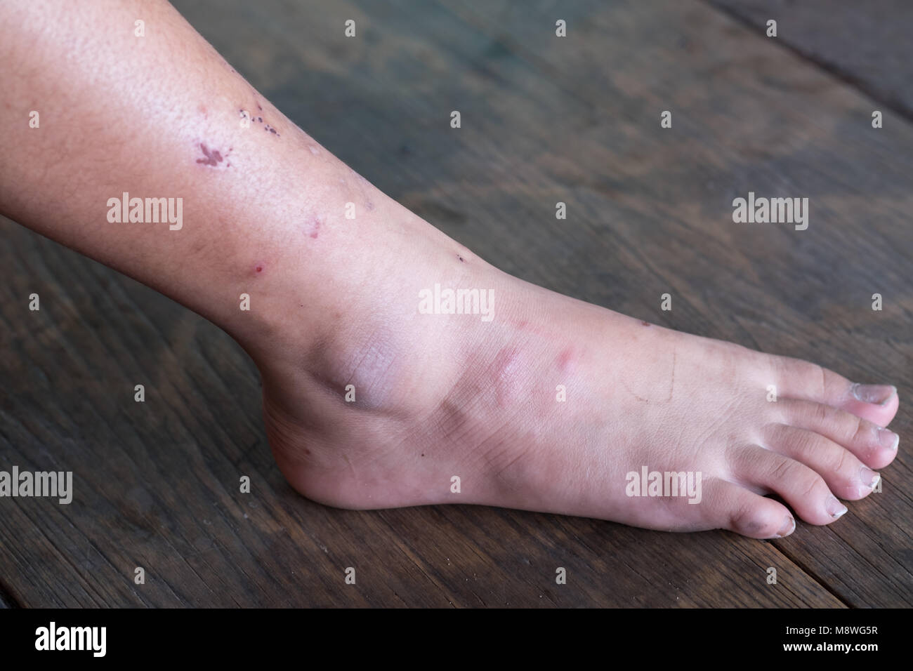 Gamba ferita, piede diabetico sindrome. Cancrena della gamba Foto stock -  Alamy