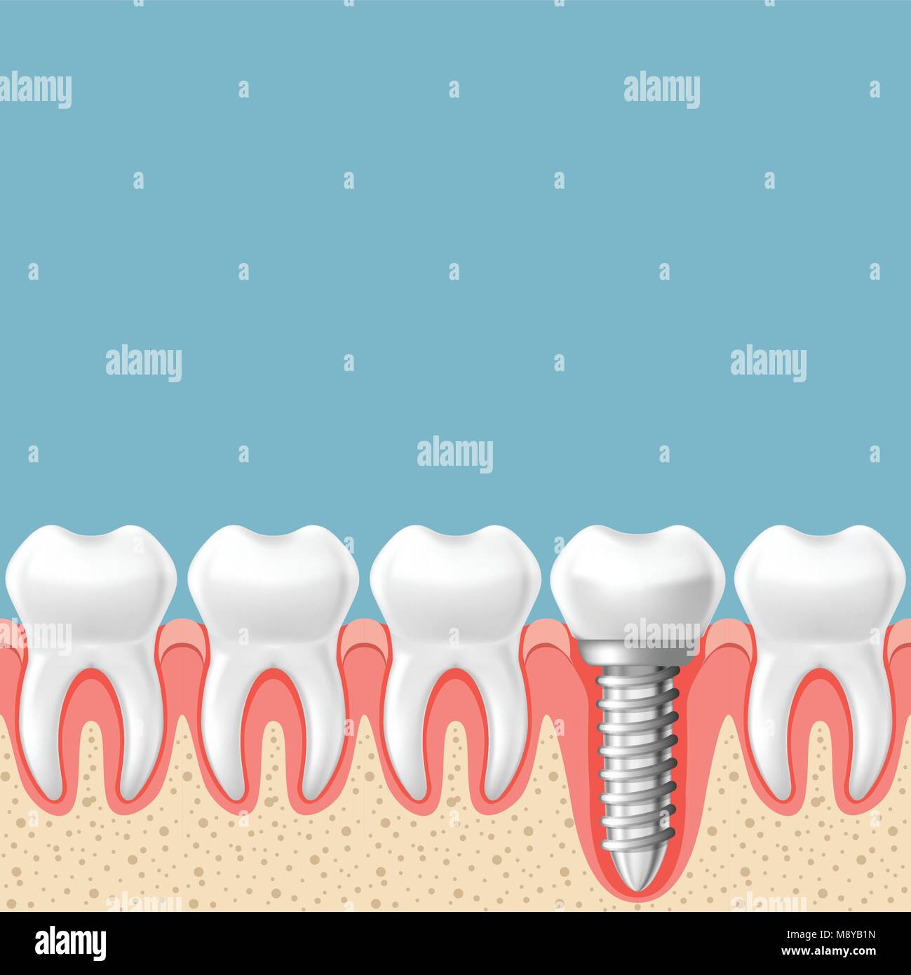 La fila di denti con impianto dentale - denti protesi schema di taglio di gomma Illustrazione Vettoriale