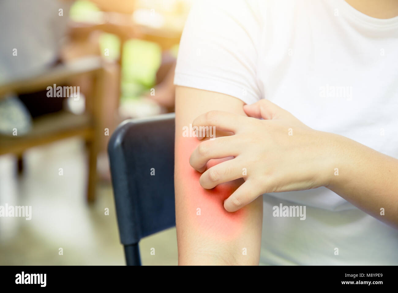 La dermatite allergia della pelle: donne mano prurito scrashing rosso pelle del braccio Foto Stock