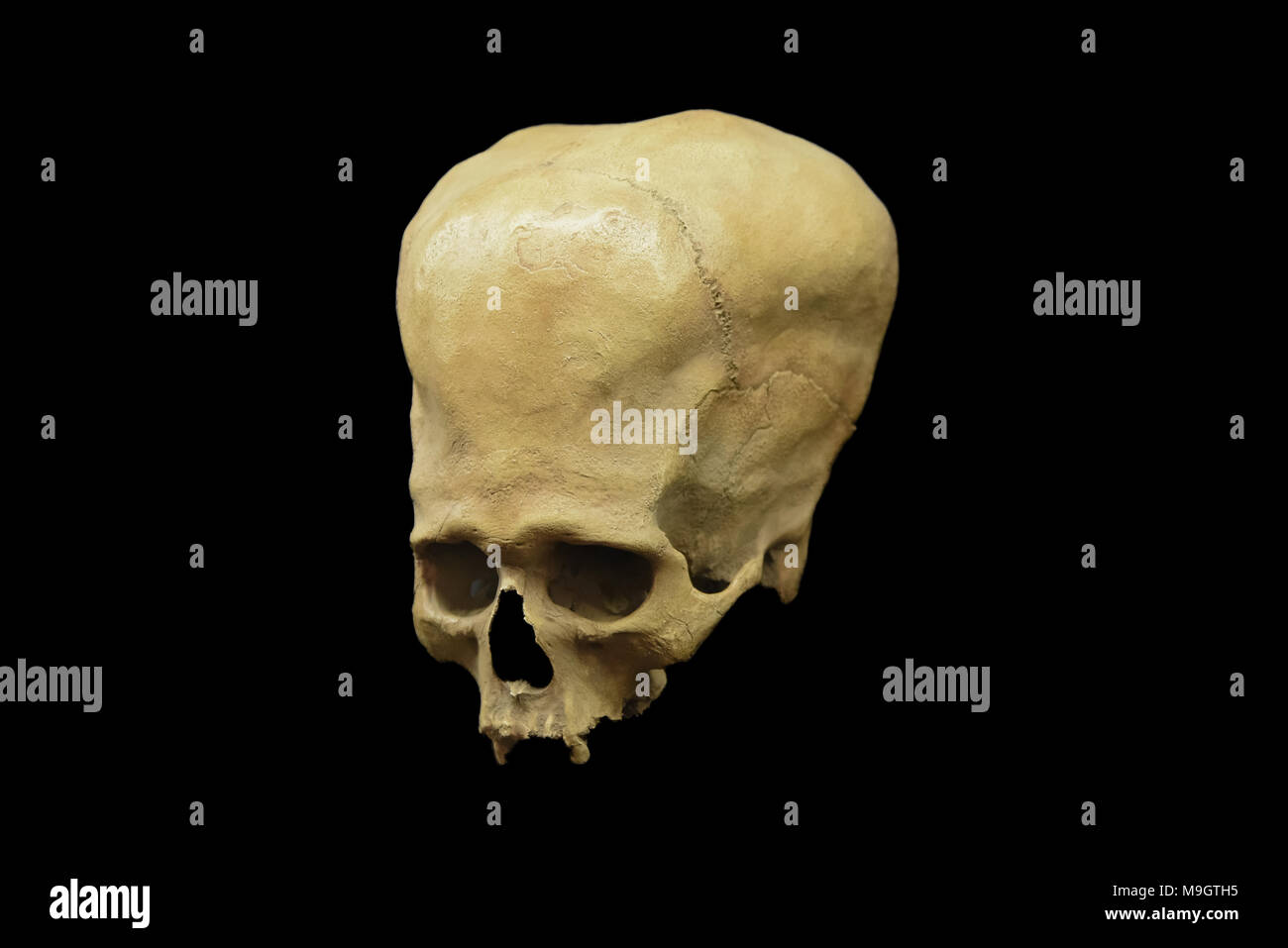 Deformato antico cranio peruviana Foto Stock