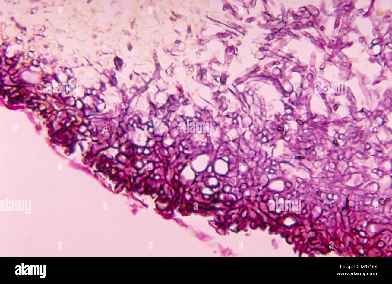 Variazioni istopatologiche in nero mycetoma granella a causa di infezioni da fungo Madurella grisea, 1970. Immagine cortesia di centri per il controllo delle malattie (CDC) / Dr Libero Ajello. Immagine cortesia CDC. () Foto Stock