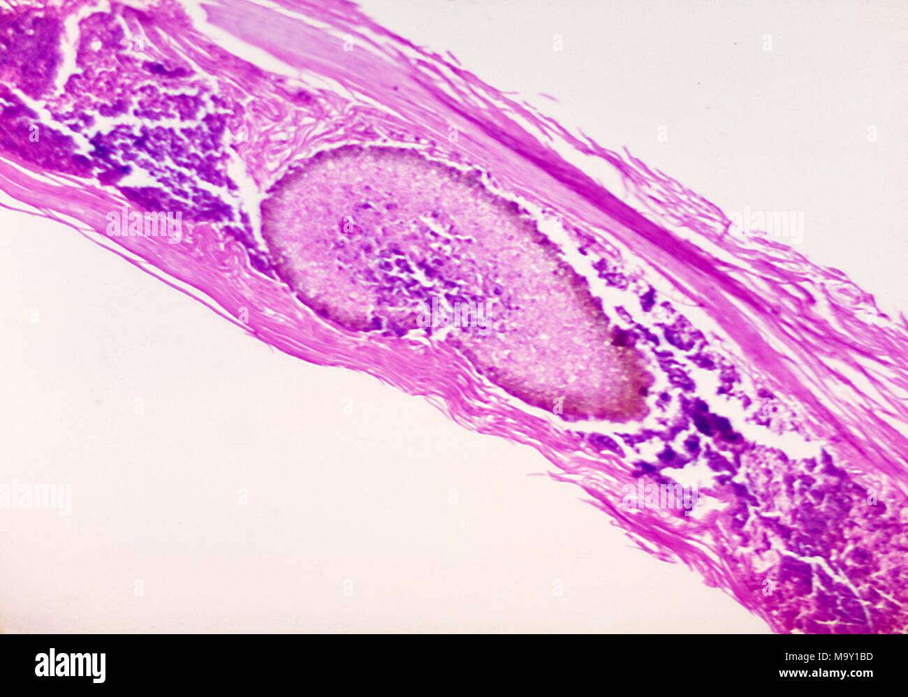 Variazioni istopatologiche associate con Madurella grisea, rivelato nella microfotografia, 1970. Immagine cortesia di centri per il controllo delle malattie (CDC). Immagine cortesia CDC. () Foto Stock