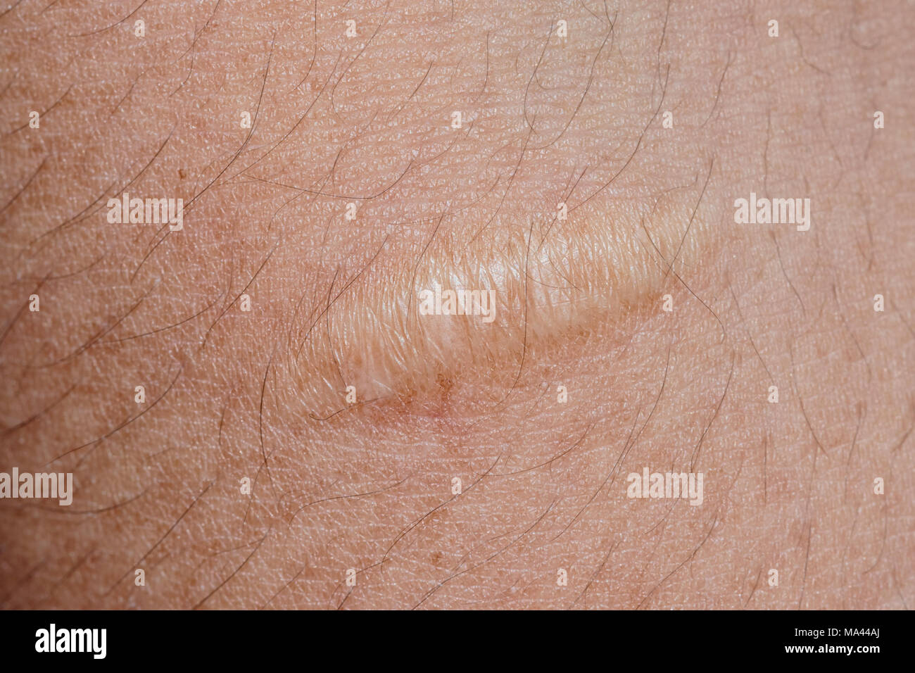 Primo piano della cicatrice cheloide su sfondo della pelle Foto Stock
