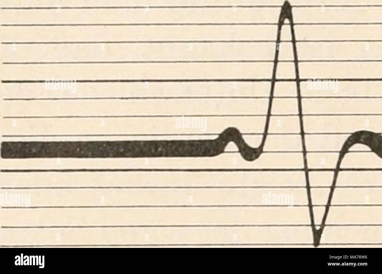 . Elektrophysiologie menschlicher Muskeln . Abb. 19. Aktionsstrom vom weißen Muse. Dal gastrocnemio des Kaninchens bei Reizung des motorischen Nerven Mit einem einzelnen Induktionsschlag und Ableitung vom Muskel mit einer Elektroden- distanz von 15 mm. (Nach Kohlrausch.) Stimmgabel: 250 Schwingungen pro Sekunde. Foto Stock