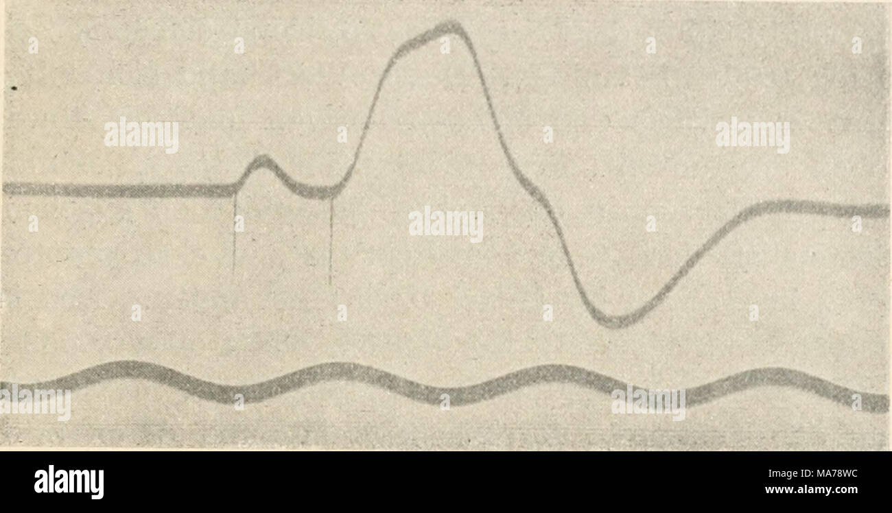 . Elektrophysiologie menschlicher Muskeln . Abb. 23. DoppoJphasischer Aktionsstroin der Unterarmflexoren. Reizung des Nervus ulnaris in der bicipite- t'urche Mit einem Offnungsinduktionsschlag. Erste Kurvenzacke durch Reizeinbrucli bewirkt. Das intervallo zwi.schen Reiz und Beginn des Aktionsstromes ist durch zwei senkrechte Markierungs- striche abgegrenzt. Stimmgabel 100 Schwingungen pro Sekunde. Foto Stock