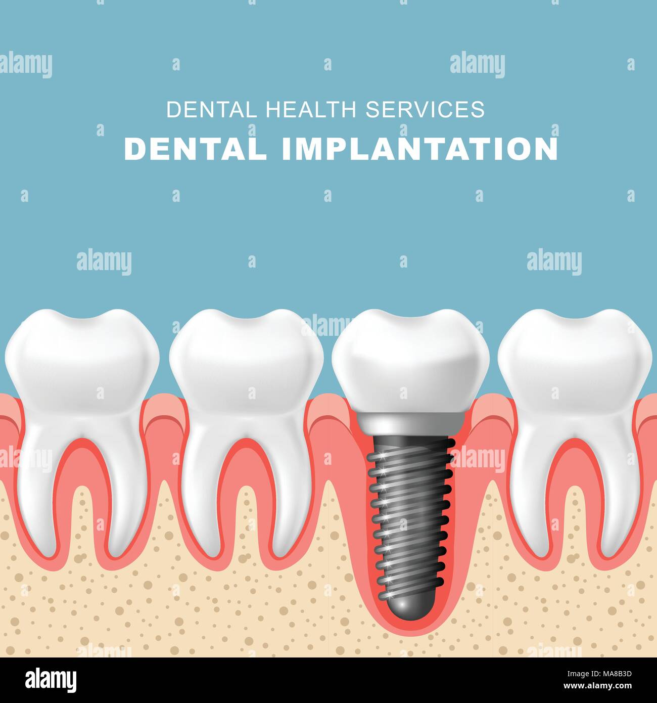 Impianto dentale - fila di denti in gomma con impianto Illustrazione Vettoriale