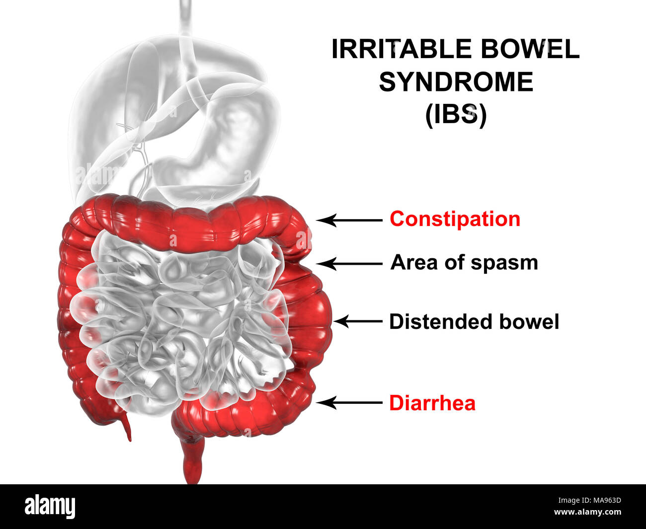 Sindrome da Intestino Irritabile. Illustrazione di un sistema digestivo che  soffrono di sindrome da intestino irritabile (IBS). IBS è noto anche come  colon spastico o sindrome del colon irritabile. Essa provoca dolore