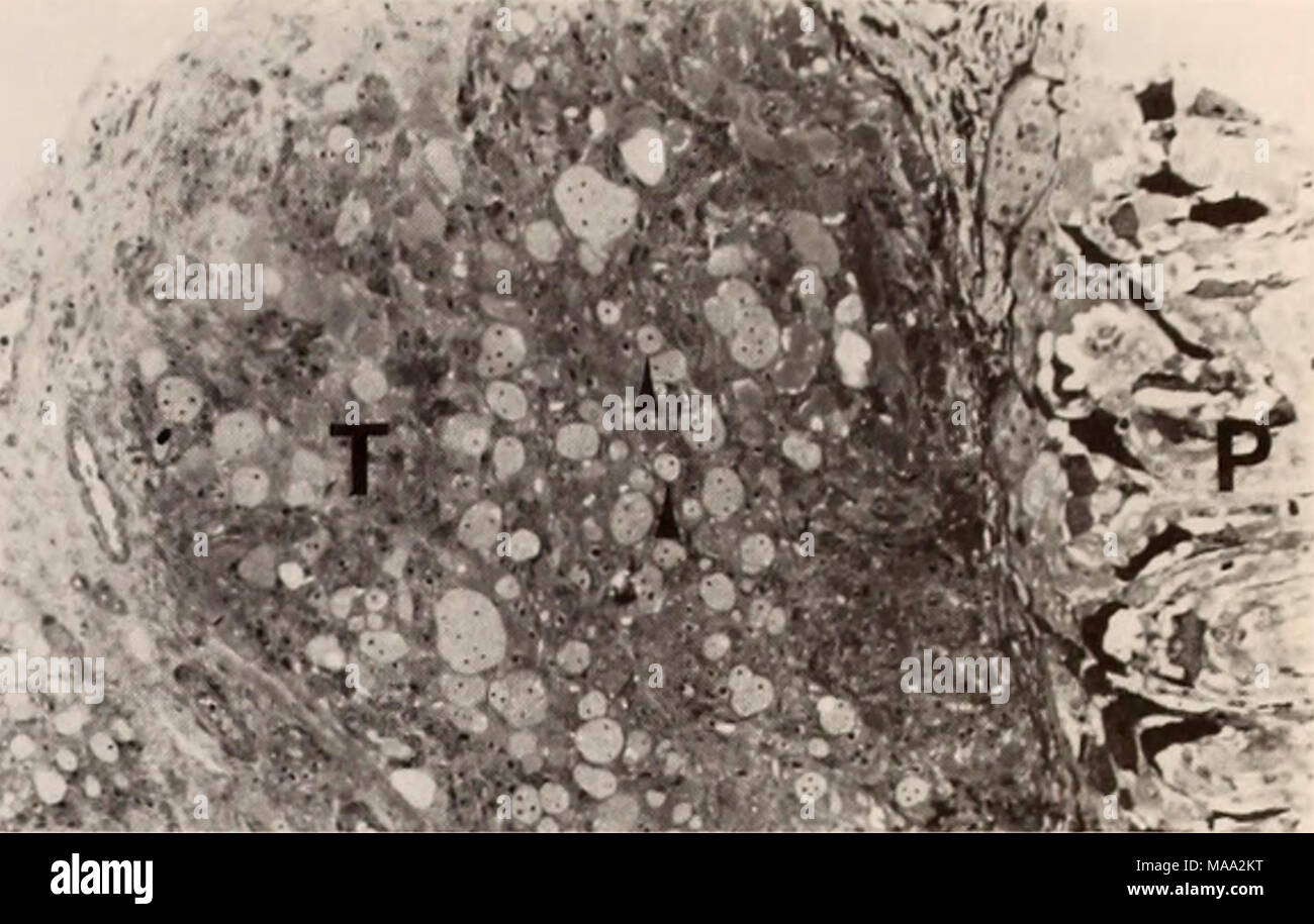 . La parte orientale del Mare di Bering ripiano : oceanografia e risorse / a cura di Donald W. cofano e John A. Calder . Figura 55-2. La fotomicrografia di una sezione di una pseudo- brachiale del tumore in un pacifico cod. Normal-figuranti pseudo- ramo (P) è adiacente al tessuto tumorale (T). Tipico X-cellule vengono identificate dalle frecce. (Blu di toluidina, X230.) recanti un tumore cod erano più comuni nel sud la porzione centrale della zona di campionamento (Fig. 55-4). Sia la frequenza delle catture con tumore-cuscinetto cod e la proporzione di pesci affetti diminuito per il nord-ovest. Merluzzo bianco non sono stati catturati nella parte orientale della s Foto Stock