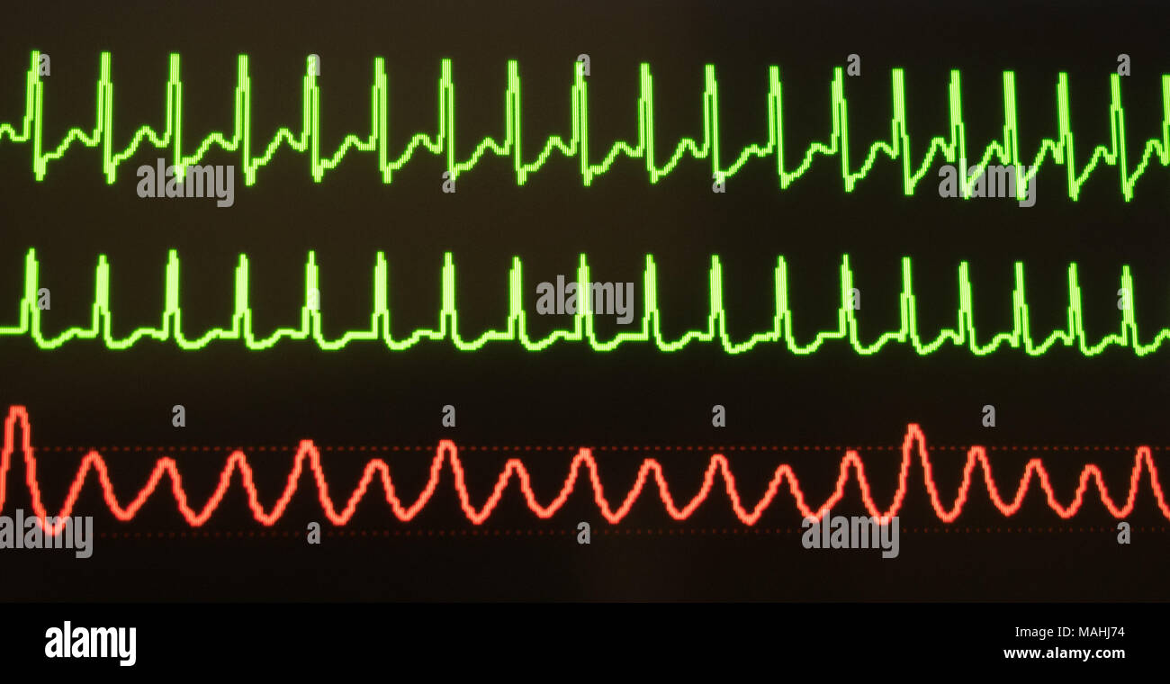Il monitor mostra tachicardia sopraventricolare in verde e la pressione del sangue arterioso in rosso su sfondo nero. Foto Stock