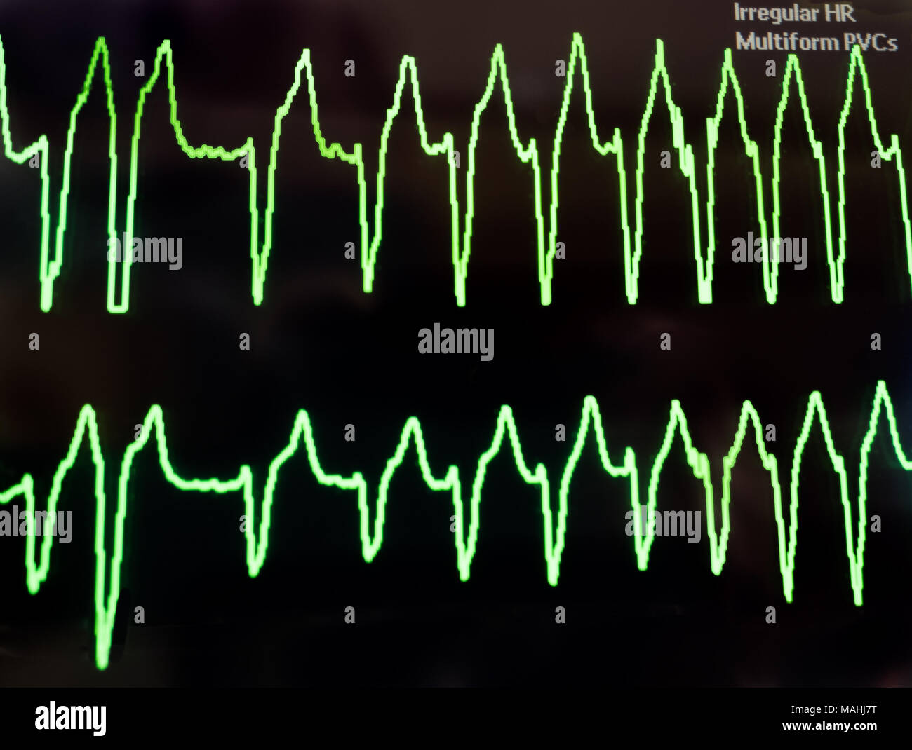 Un elettrocardiogramma che mostra la tachicardia ventricolare in neon linee verde sullo sfondo nero di un monitor. Foto Stock