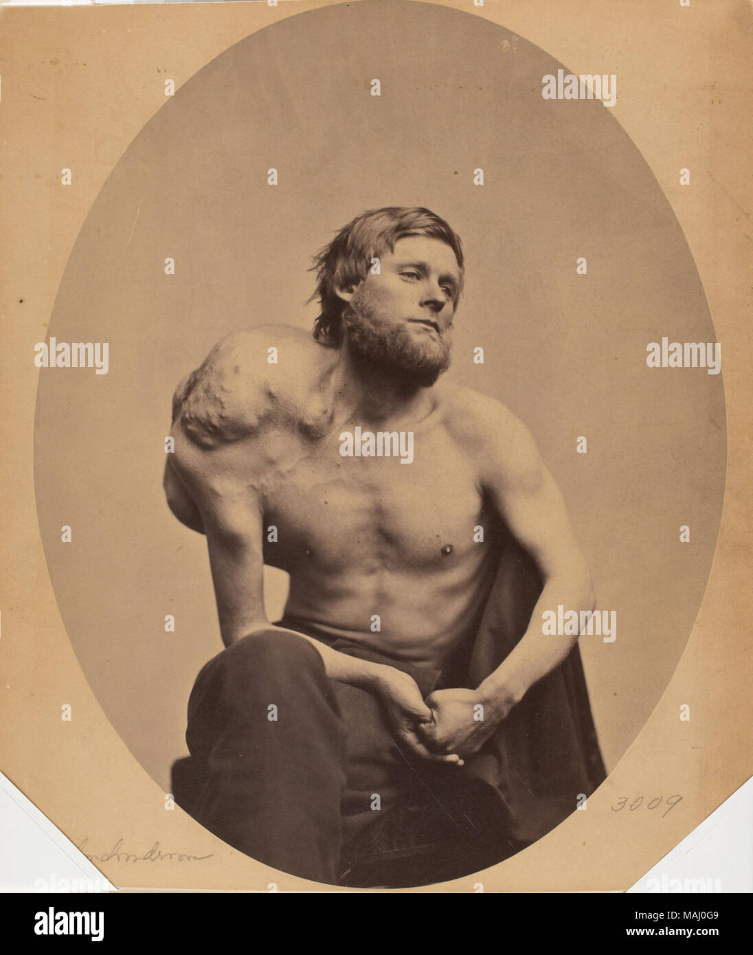 2008-62 . Enchondroma della scapola. 1863 Foto Stock