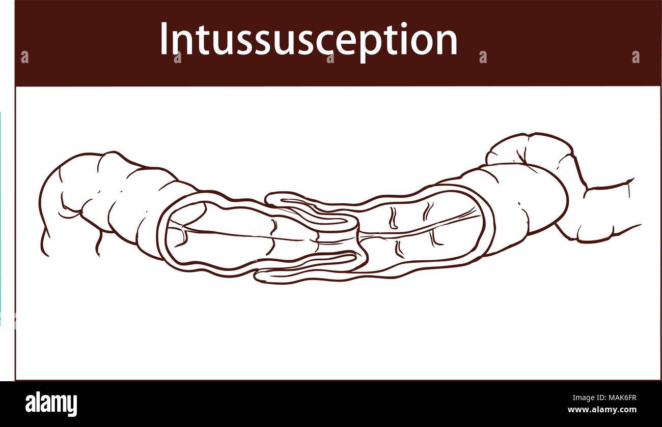 Illustrazione vettoriale di intussusception dell intestino. ostruzione. Illustrazione Vettoriale