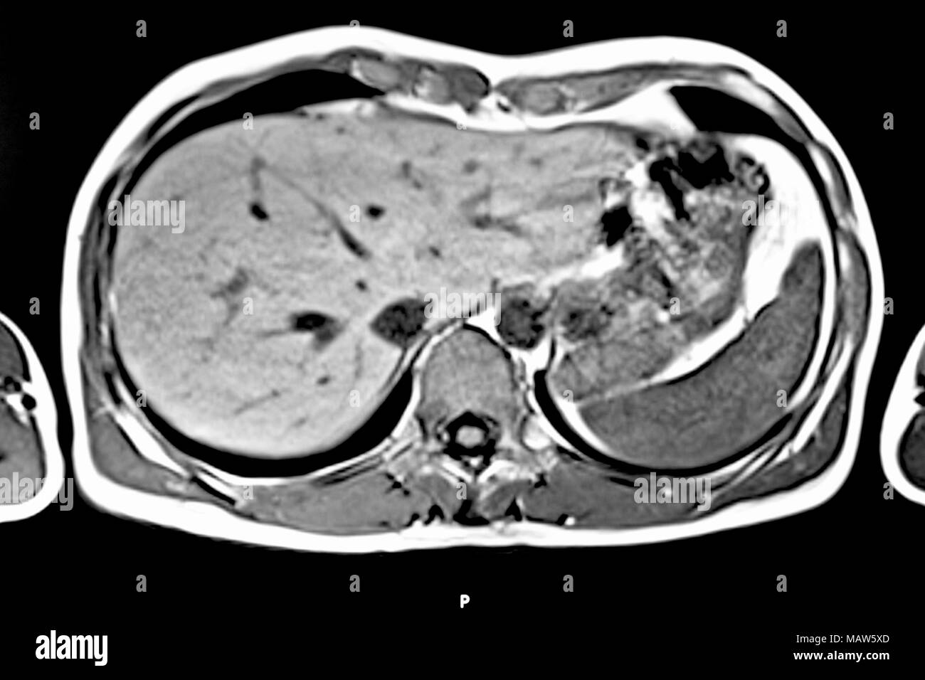 MRI scan dell umana torace e addome, vista trasversale. Ben riconoscibili sono il fegato, la milza e il midollo spinale Foto Stock