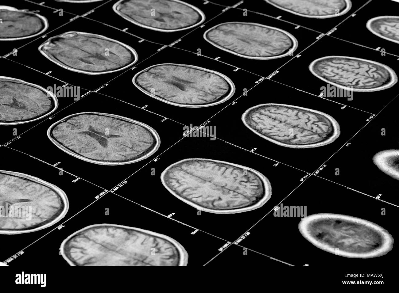 Vista prospettica di una scansione MRI del cervello umano (vista trasversale) Foto Stock